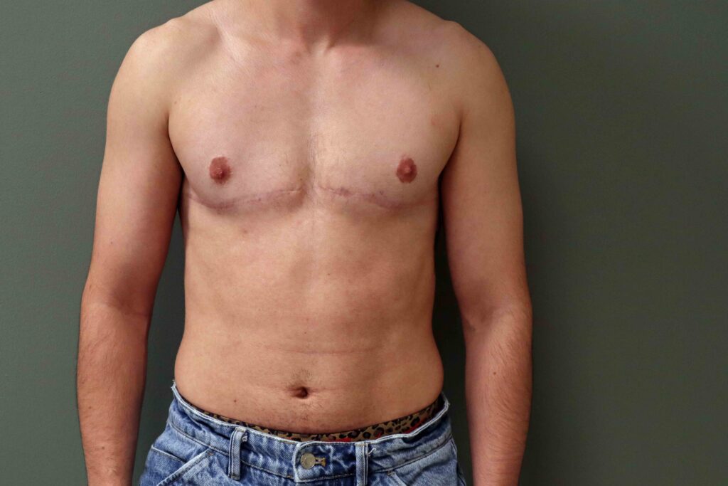 ftm top surgery